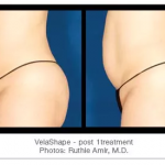 Velashape Skin Tightening Before and After