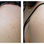 cellulite reduction therapy