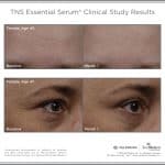 Dermalase TNS ES Clinical Studies Female Age40 and 47