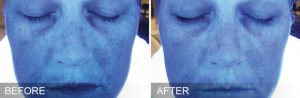 dermalase before after hydration