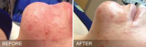 Dermalase before after oily congested