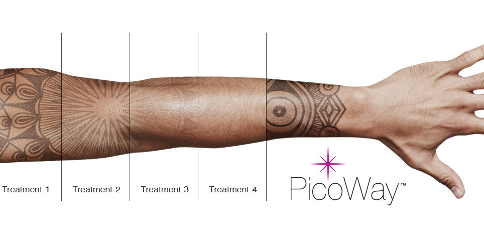 picoway permanent tattoo removal