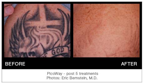 The Valleys Best Tattoo Removal with the exclusive PicoWay laser Call  8552DELETE to receive a complimentary consultation at either our Boston or  Phoenix salo