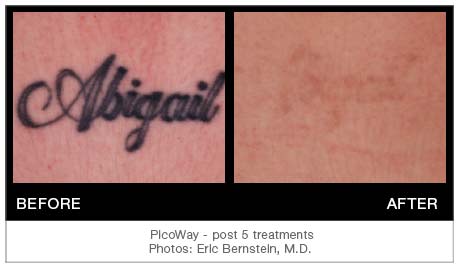 Laser Tattoo Removal NY  Bye Bye Ink  Best Laser  PicoWay